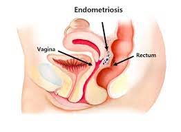 Bowel Endometriosis after Menopause