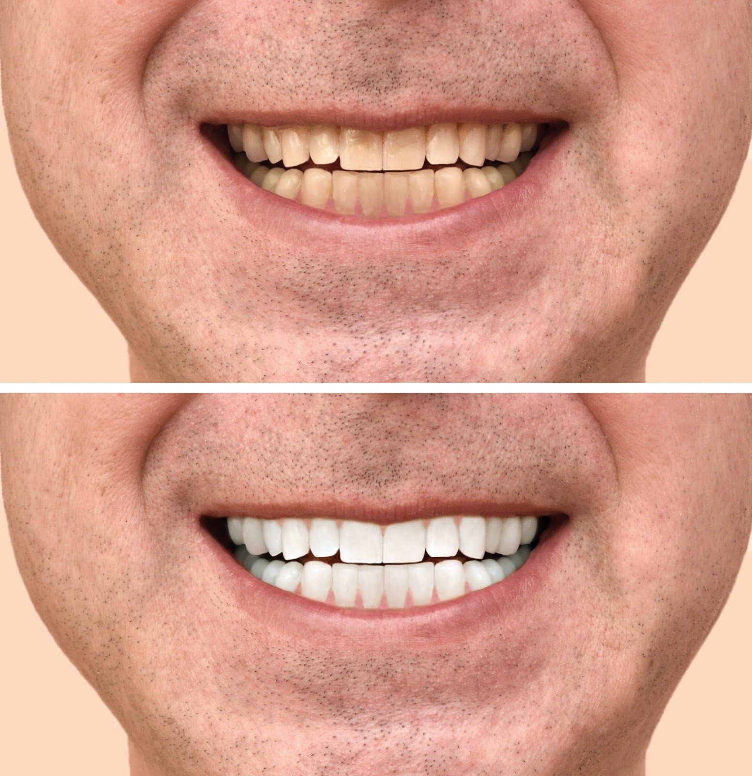 dental veneers in Burnaby