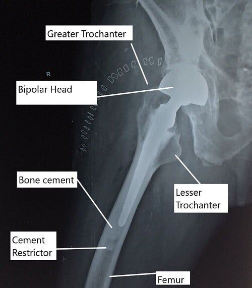 X-ray of the hip in lateral view showing a partial cemented hip replacement.