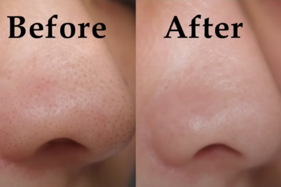 Vùng da mũi láng mịn chỉ sau 2 tuần áp dụng