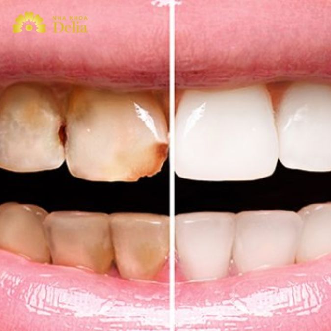 Răng sứ kim loại bị đen có ảnh hưởng gì không?