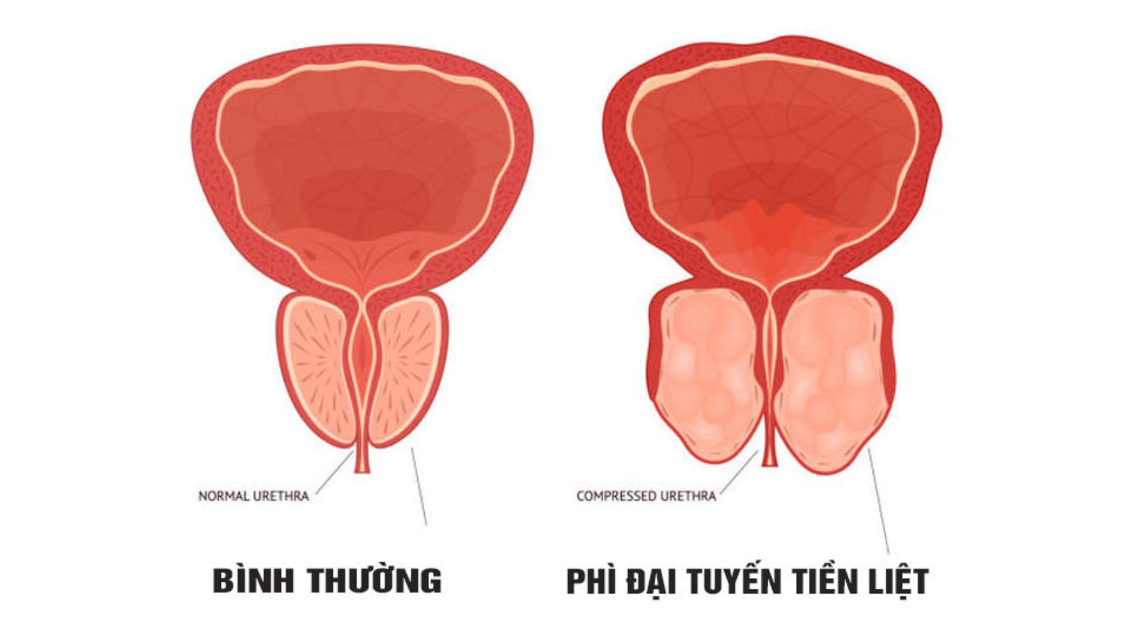 tieu-ra-mau-co-tu-khoi-khong-nguyen-nhan-tieu-ra-mau 3