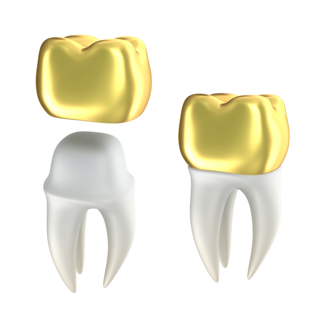 White Gold Dental Crown