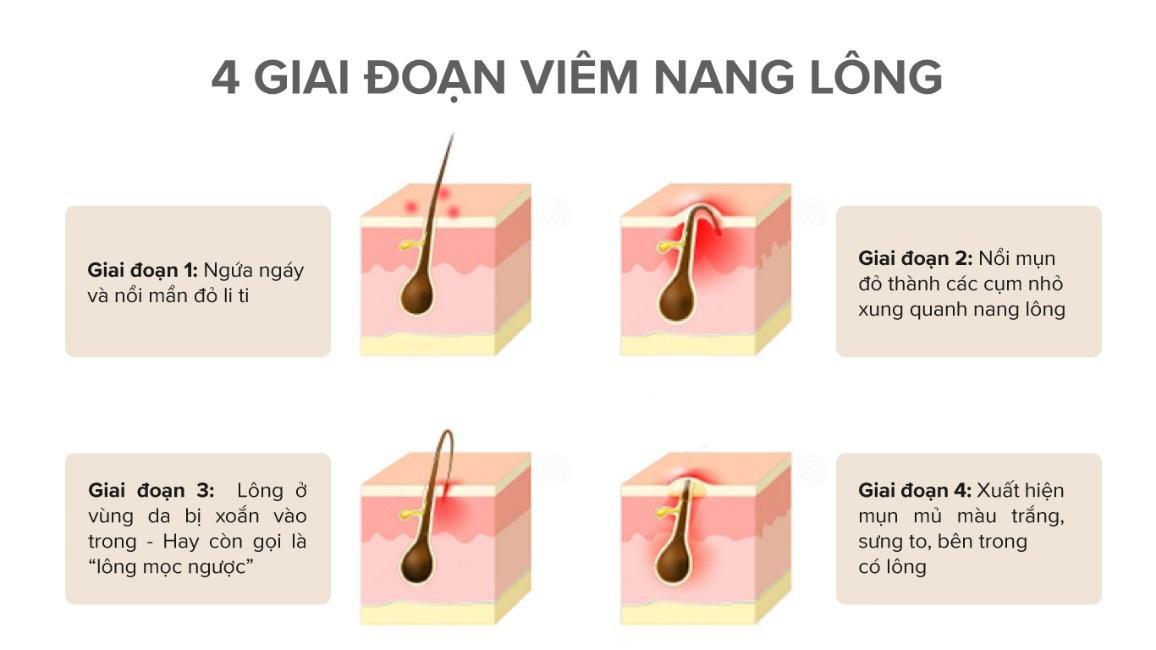 giai-doan-viem-nang-long