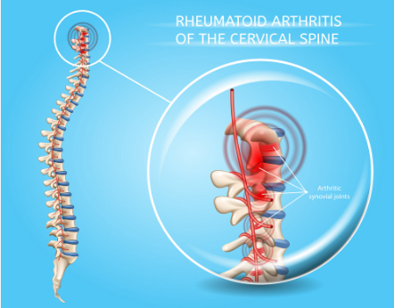 How Does Rheumatoid Arthritis Affect the Cervical Spine?