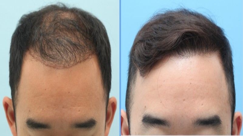 NewHair By Khơ Thị điều trị rụng tóc, hói đầu uy tín tại TPHCM