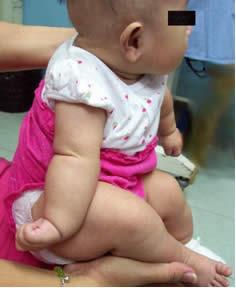 baby with an abnormal upper limb
