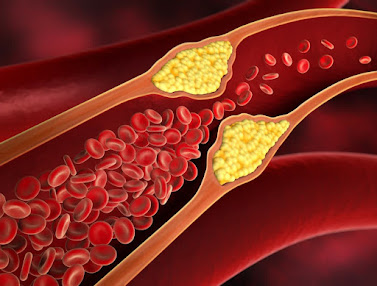 What Are the Symptoms of High Cholesterol? | Everlywell