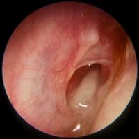 Acute Otitis Media - Perforation