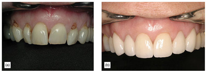 before and after teeth whitening and veneers