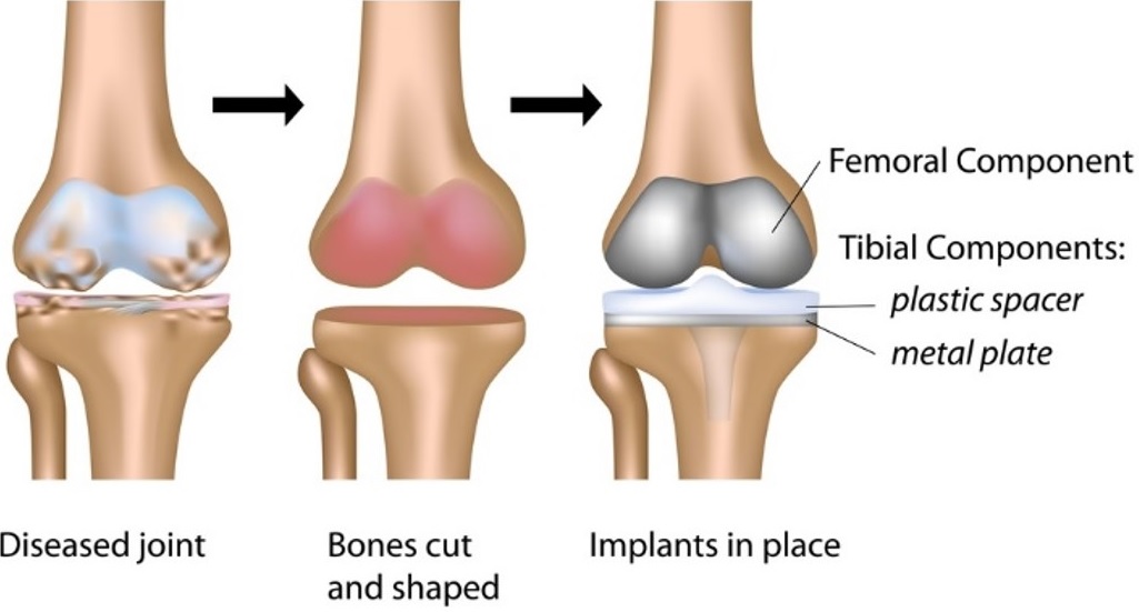 Complex or revision knee replacement