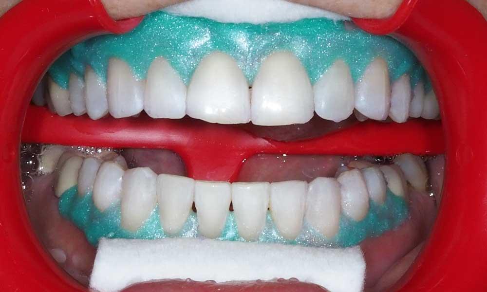  teeth whitening in Scarborough