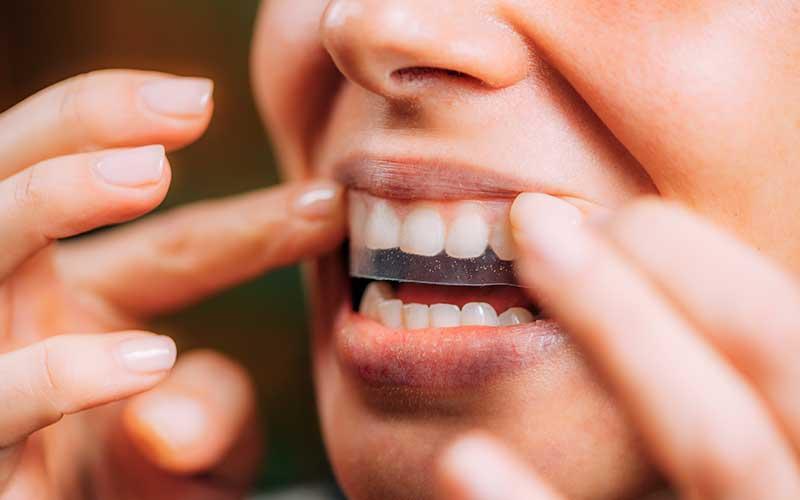 How Long Does Teeth Whitening Last? Top 5 Tooth Whitening Methods Compared
