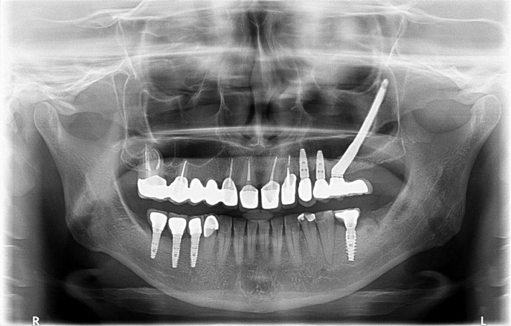 Zdjęcie szczęki z implantami zębów przygotowane przez rezonans