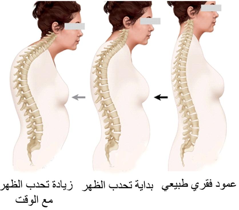 E:\Documents and Settings\USER\Desktop\كبار السن\مقارنة تحدب الظهر.jpg