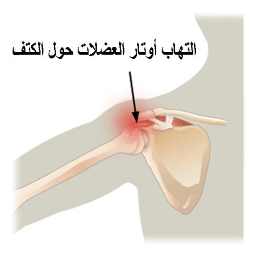 التهاب أوتار العضلات حول الكتف.jpg