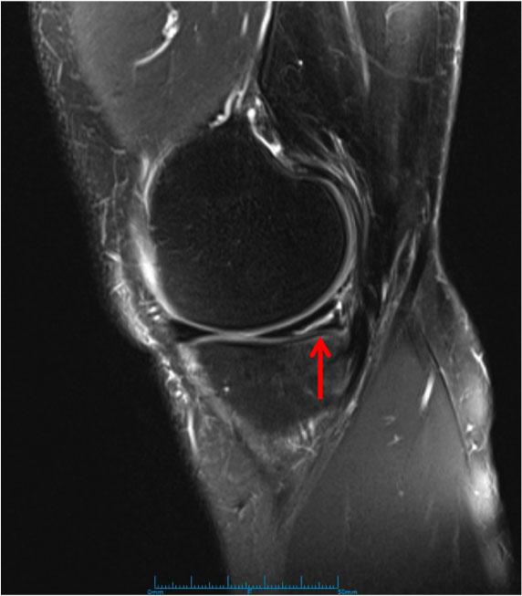 Image result for meniscus tear mri