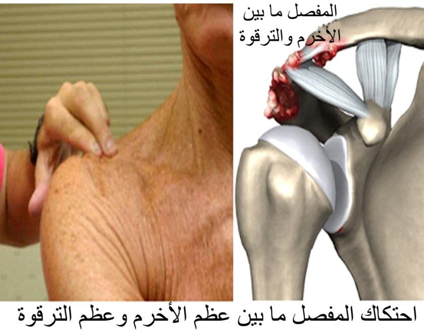 E:\Documents and Settings\USER\Desktop\كبار السن\ac joint.jpg