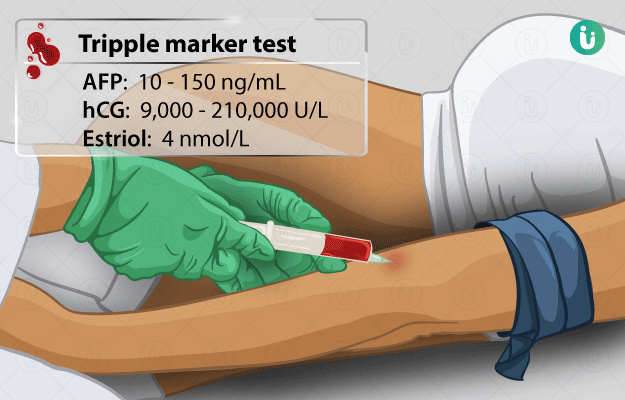 Triple Marker Test: Procedure, Purpose, Results, Normal values, Cost,  Price, Online booking