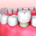 Cách khắc phục tình trạng nhiễm trùng do sử dụng cầu răng sứ