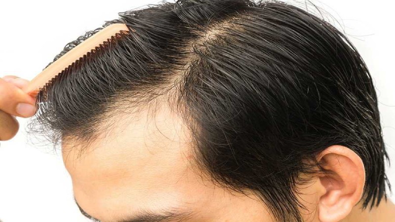 Phương pháp điều trị rụng tóc hói đầu bằng cấy Hair Cells Nano Ion vi điểm