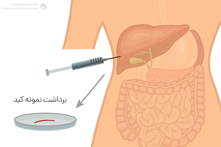 نمونه برداری برای تشخیص کبد چرب