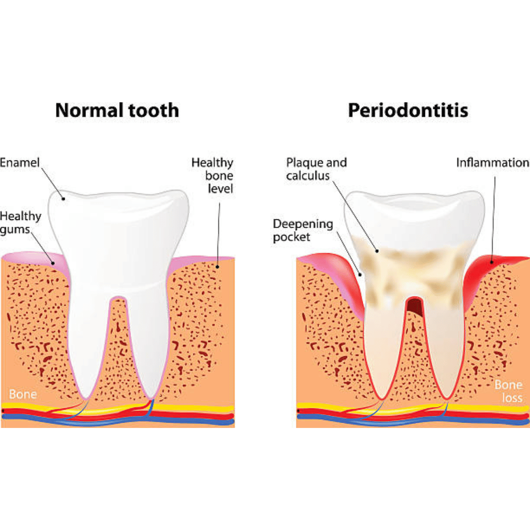 Revolutionize Oral Health with SmileStudio: Why Deep Dental Cleaning is Essential