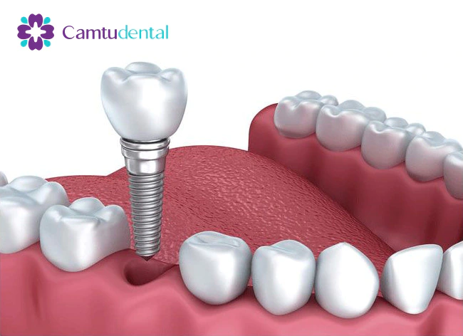 mô phỏng trồng răng Implant tại Nha khoa Cẩm Tú Quận 1