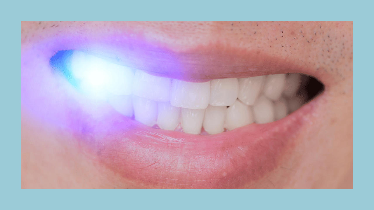 how long does laser teeth whitening work