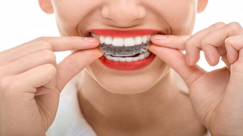 Invisalign treatment in Toronto