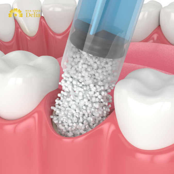 Ghép xương răng nhằm mục đích tăng thể tích xương hàm