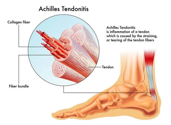 achilles-tendonitis