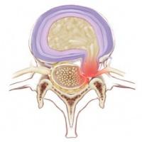 https://www.physio-pedia.com/images/thumb/d/d6/Disc_extrusion.jpg/200px-Disc_extrusion.jpg