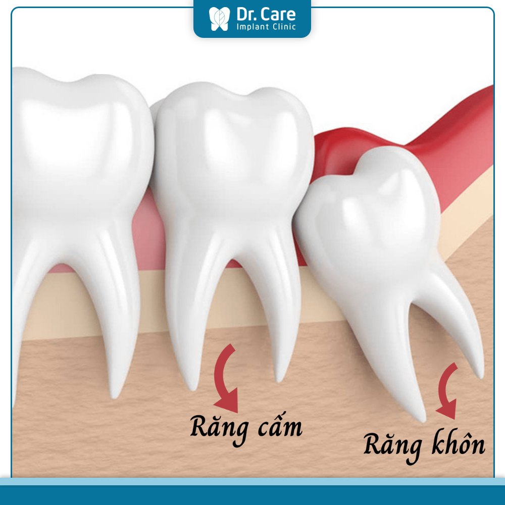 Phân biệt răng cấm và răng khôn