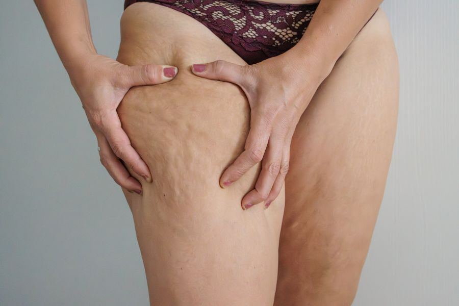 Lipedema, você sabe o que é? Descubra o impacto na vida da mulher