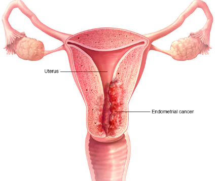 Uterine Cancer or Precancer: