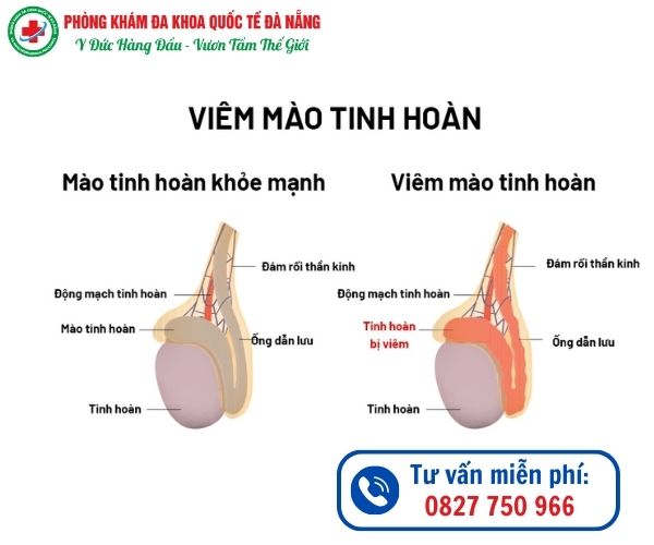 Viêm mào tinh hoàn