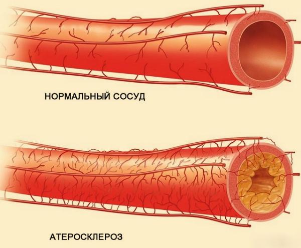 Лишь 50 мл в день этого мощного напитка очищают артерии и предупреждают сердечный приступ