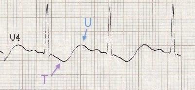 ECG U wave Hypokalemia