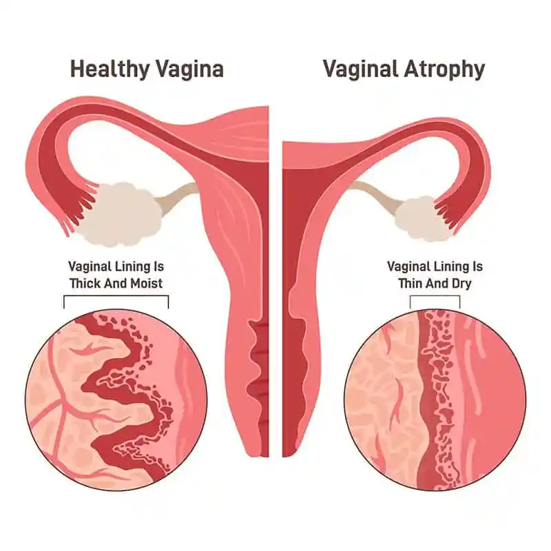 Atrophic Vaginitis