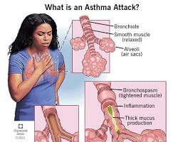 Asthma