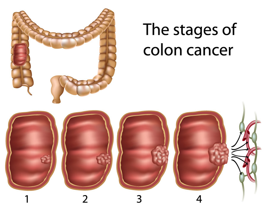 Stages of Colon Cancer