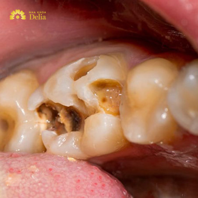 Nguyên nhân khiến răng hàm lung lay: sâu răng