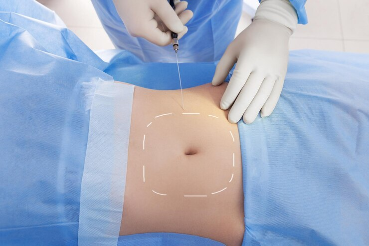 What are the Top Benefits of Liposuction Surgery?