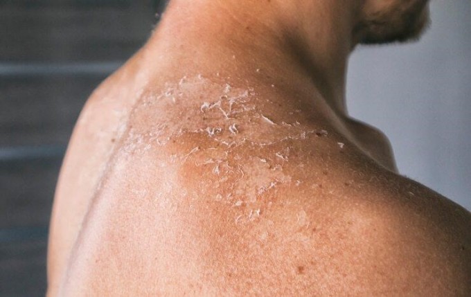 Tia UV gây ra nhiều tổn thương trên da và có thể dẫn đến ung thư da