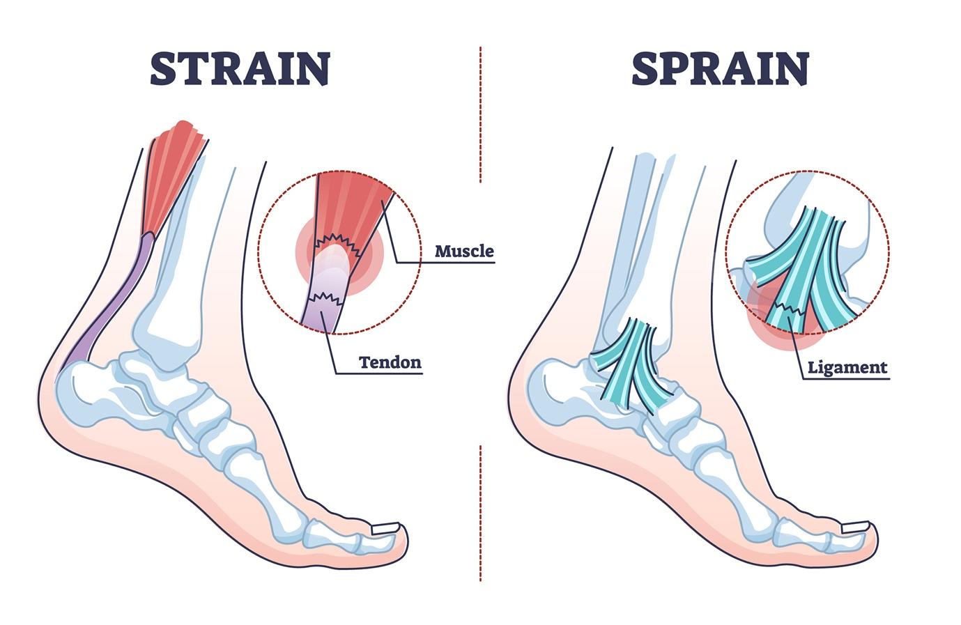strain-vs-sprain