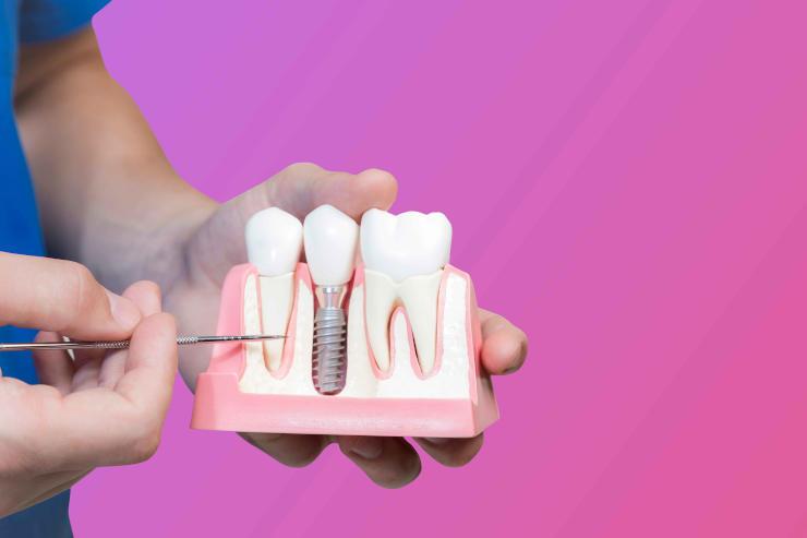 ایمپلنت دندان چقدر عمر می‌کند؟
