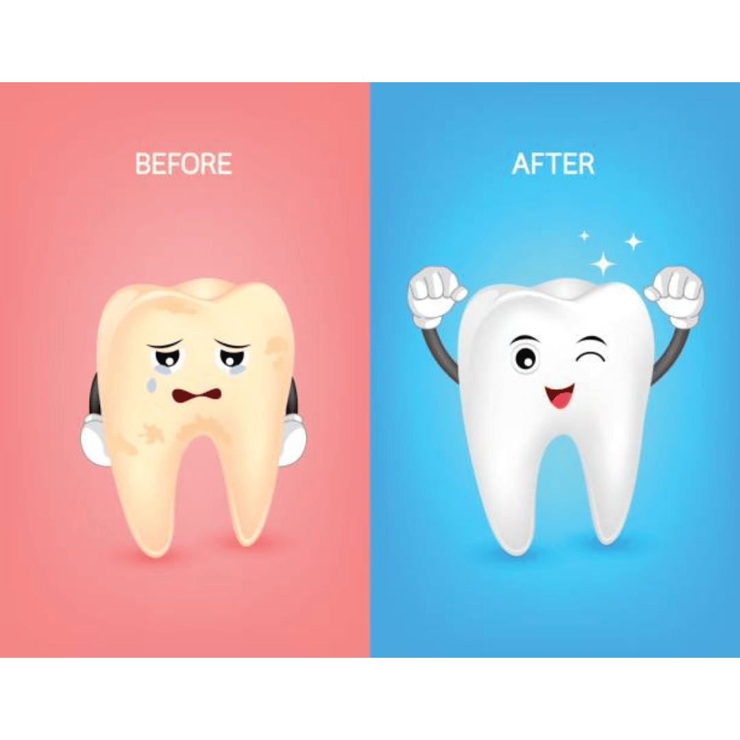 Teeth Sealants Pros and Cons