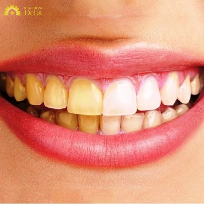 Răng ố vàng là tình trạng thay đổi màu sắc của răng
