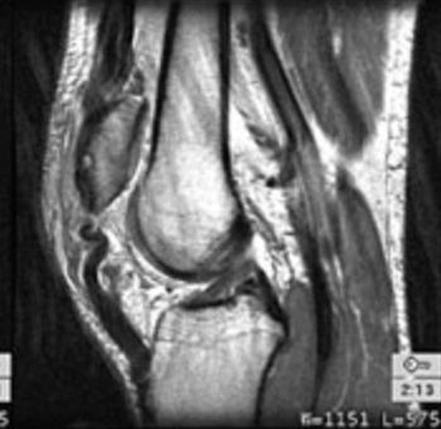 Image result for patellar tendon tear mri
